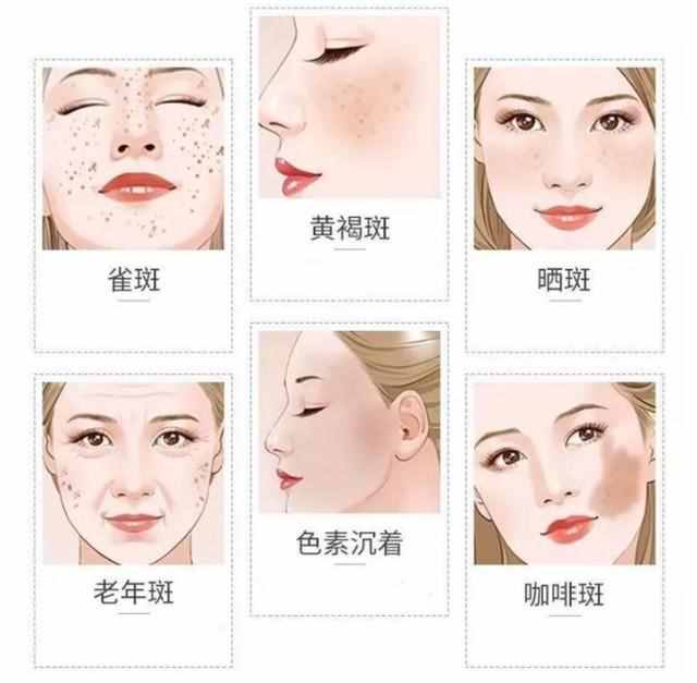 什么方法可以去斑，去斑最有效的方法有哪些