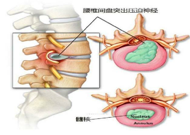 治疗腰间盘突出(经方治疗腰椎间盘突出) 腰间盘突出治疗秘方_腰间椎盘突出注意事项_野杨梅树根可以治腰间突出吗