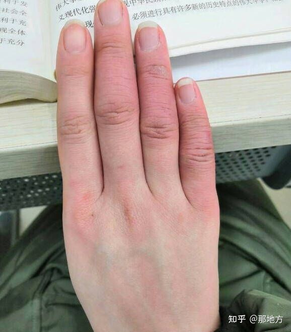 治疗冻疮的偏方_治疗冻疮的30个偏方 太实用了_冻疮治疗偏方