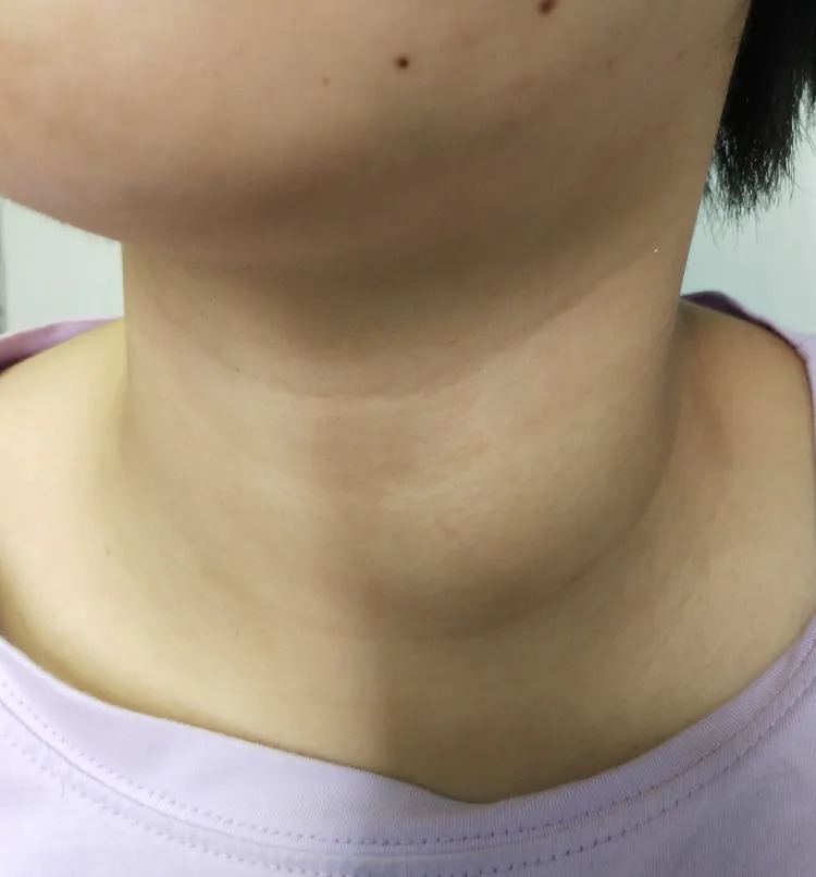 右侧甲状腺结节图片