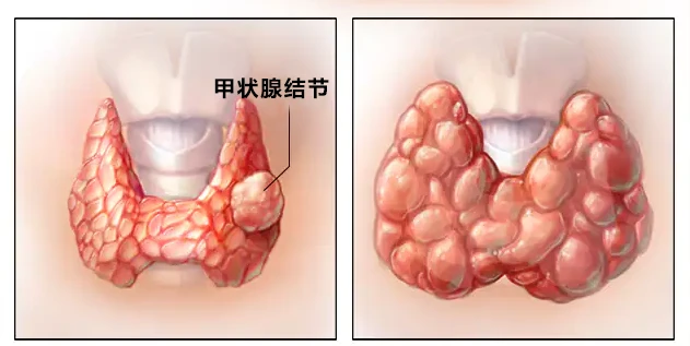 治疗单纯性甲状腺肿大_甲状腺肿大治疗偏方_治疗甲状腺肿大最好