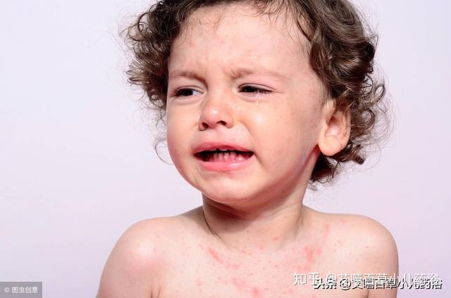 宸荨灿白是宸荨樱桃吗_丘荨性荨麻疹严重吗_寒冷性荨麻疹偏方