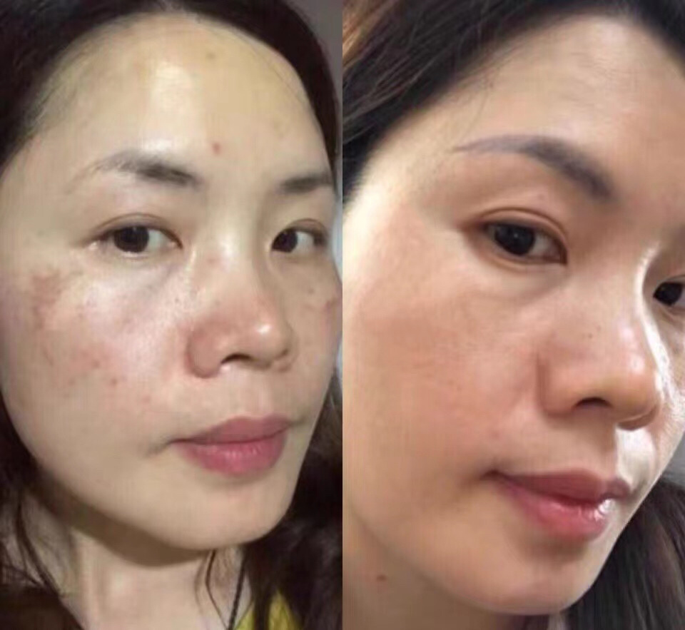 祛黄褐斑的偏方_祛黑祛黄_祛痘痘偏方