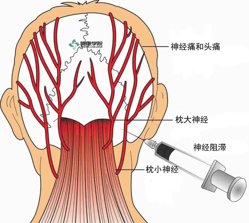 神经衰弱性头疼怎么办_顽固性头疼秘方_根治一切顽固性头疼秘方