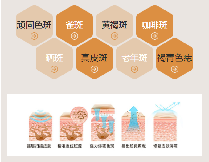 斑好除么_除斑偏方_怎样除妊娠斑