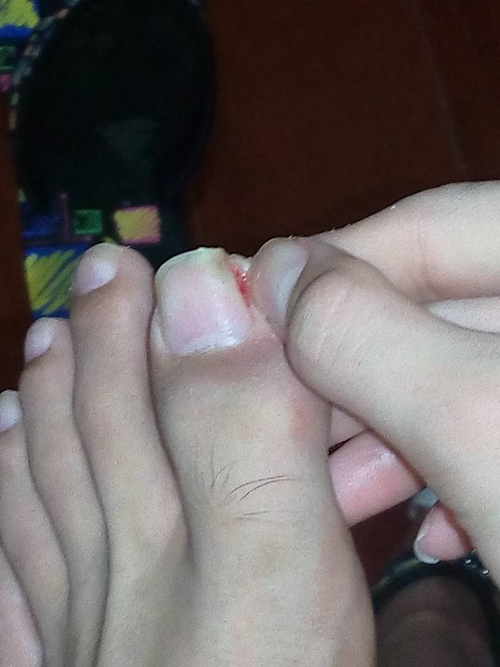 灰指甲怎么治疗四大方法远离灰指甲 潮南区峡山哪里有看灰指甲的_治疗灰指甲的偏方_灰指曱有什么偏方冶了