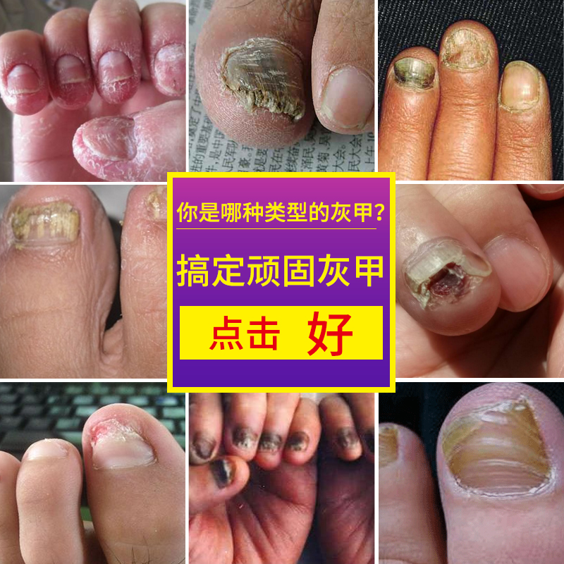 灰指甲怎么治疗四大方法远离灰指甲 灰指曱有什么偏方冶了_潮南区峡山哪里有看灰指甲的_治疗灰指甲的偏方