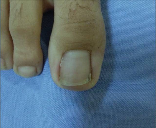 灰指甲怎么治疗四大方法远离灰指甲 治疗灰指甲的偏方_灰指曱有什么偏方冶了_潮南区峡山哪里有看灰指甲的