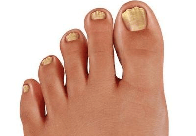 灰指甲怎么治疗四大方法远离灰指甲 治疗灰指甲的偏方_灰指曱有什么偏方冶了_潮南区峡山哪里有看灰指甲的