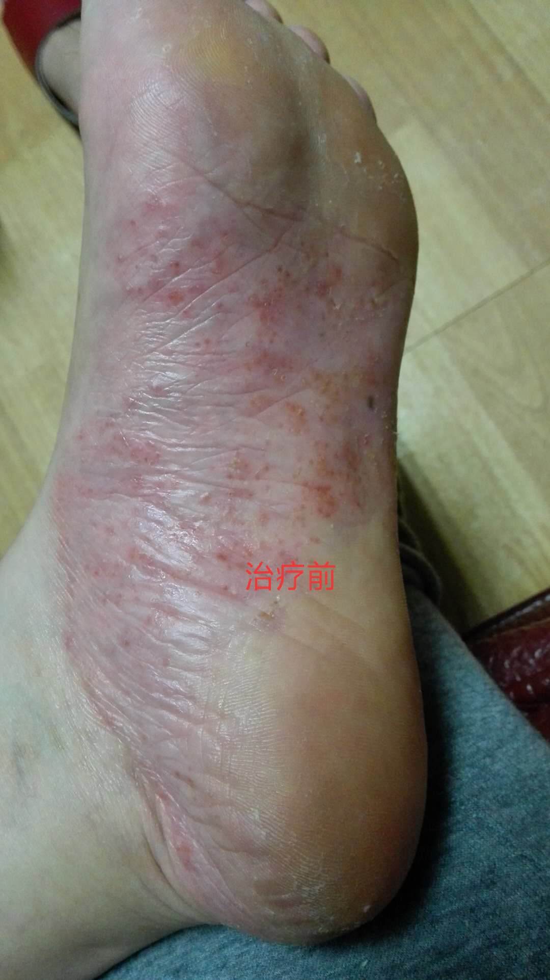 灰指甲怎么治疗四大方法远离灰指甲 灰指曱有什么偏方冶了_治疗灰指甲的偏方_潮南区峡山哪里有看灰指甲的