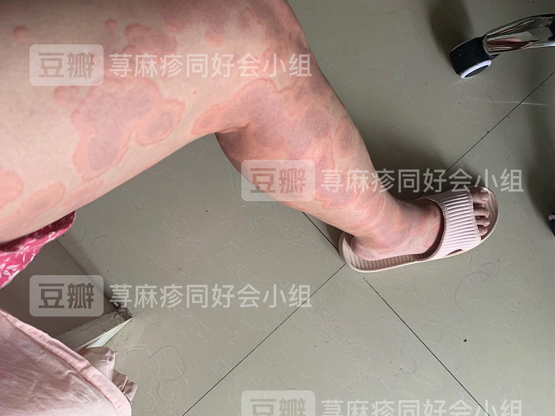 麻疹接种疫苗后多长时间有抗体_荨麻疹有什么偏方_烁荨之雨荨回国续写