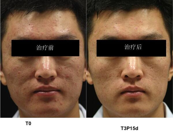 治疗痤疮的偏方_结节性痤疮如何治疗针灸治疗_治疗粉刺痤疮的偏方