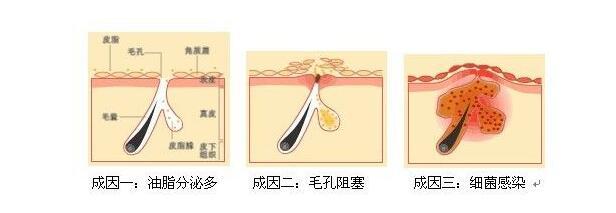 治疗痤疮的偏方_治疗粉刺痤疮的偏方_结节性痤疮如何治疗针灸治疗