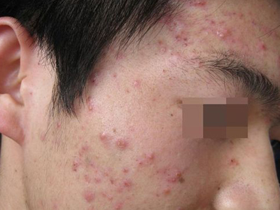 治疗粉刺痤疮的偏方_结节性痤疮如何治疗针灸治疗_治疗痤疮的偏方