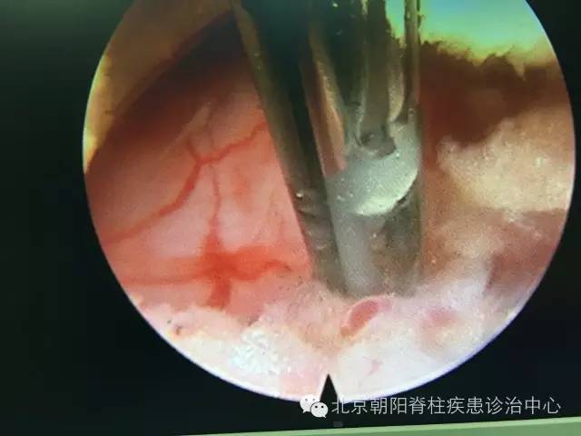 “腰突”，那些不得不说说的事儿