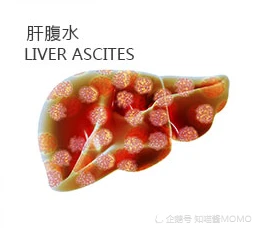 肝癌晚期腹水脚肿偏方_肝癌腹水偏方_肝癌腹水中医治疗