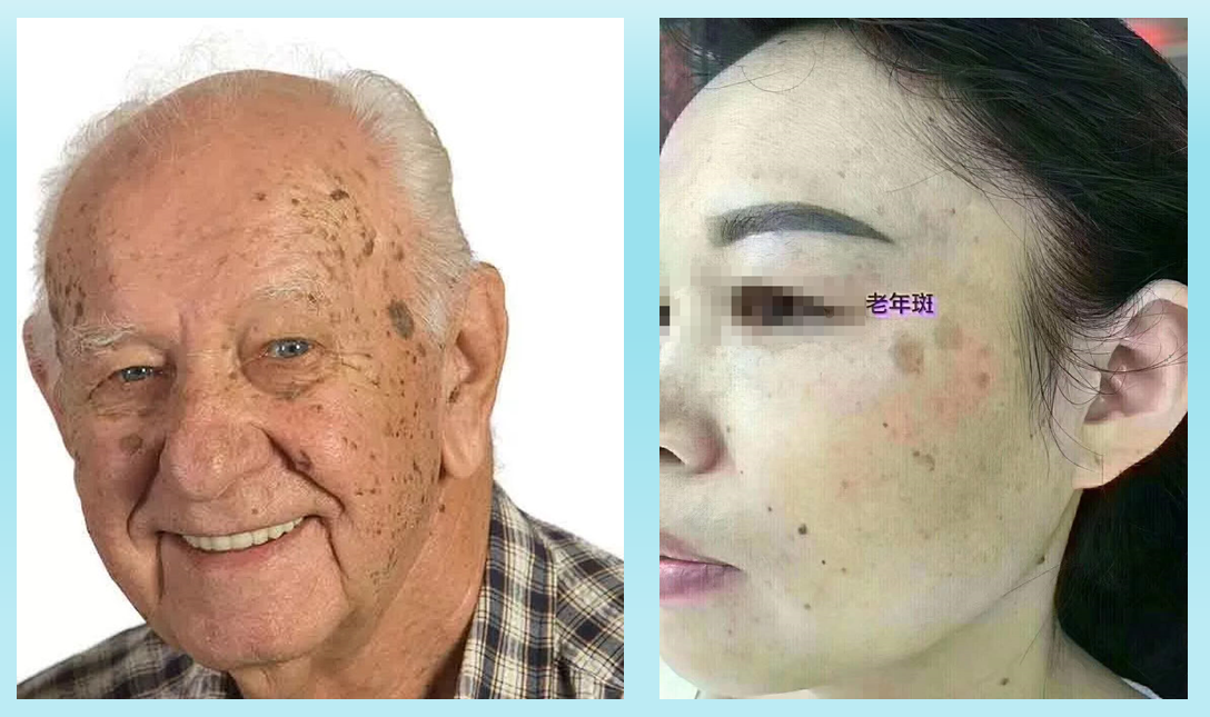 治疗小儿斑秃的偏方_老年人脸上起斑_去老年斑偏方