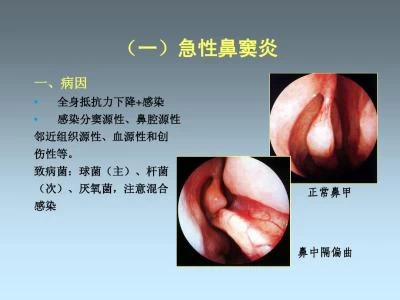 过敏性鼻炎偏方_偏方治过敏鼻炎奇效_过敏鼻炎治疗偏方