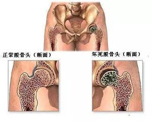 胡骨头坏死怎么治疗_骨头坏死 治疗_治疗股骨头坏死秘方