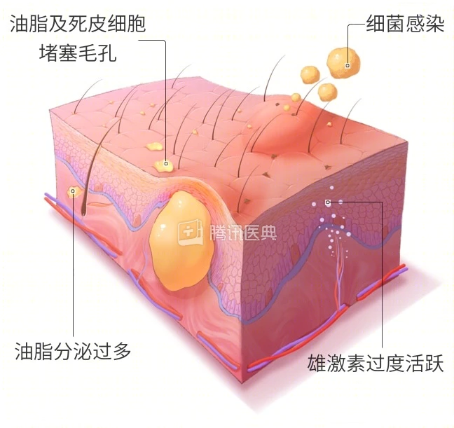 去汗毛偏方盐和醋_去汗毛的偏方_去脸上汗毛偏方牛奶