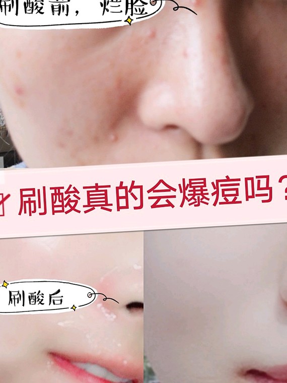 快速祛痘六个小偏方 偏方快速祛痘_怎么快速祛痘和祛痘印_快速祛痘偏方