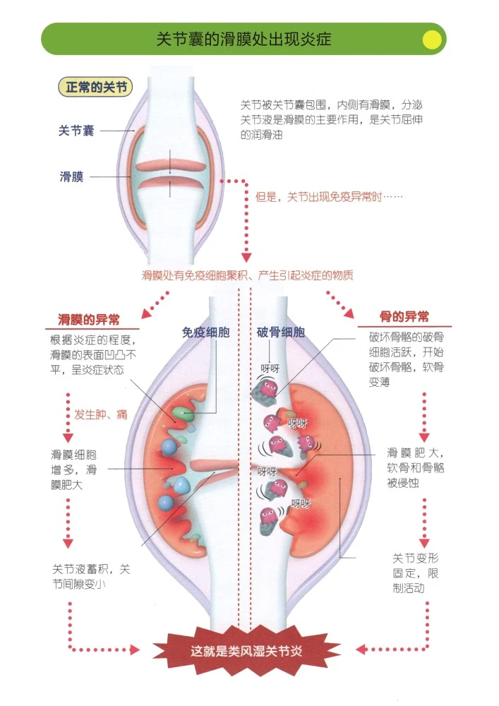 粘连性关节囊炎治疗_游走性关节炎的偏方_类风湿性关节炎偏方