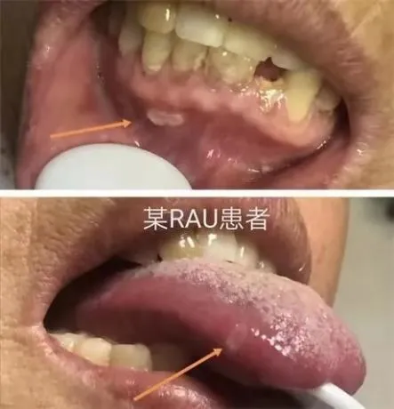 治疗口腔溃疡的偏方_口腔没有溃疡但是烧灼疼痛感_糖尿病口腔大面积溃疡愈合的秘方