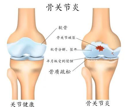 得了类风湿关节炎?几招教你自我治疗 风湿关节痛的偏方_左肩粘连性关节囊炎_类风湿性关节炎偏方