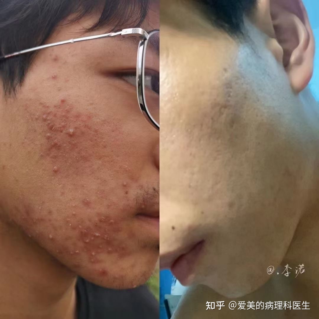 怎样去除脸上痘坑偏方_人药治鸽病大全治鸽痘_治痘偏方