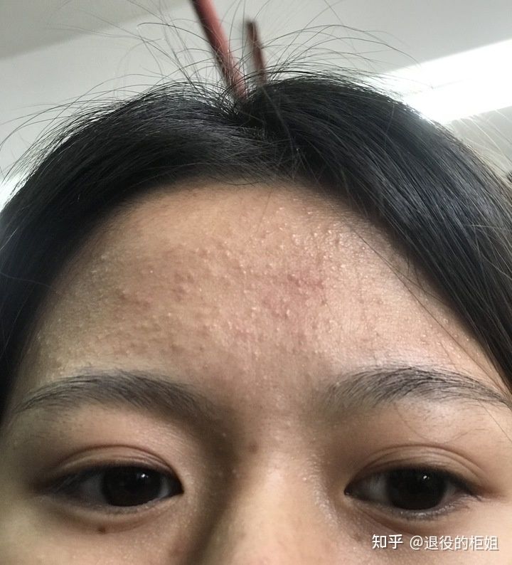 治痘偏方_胡兵偏方治胃肠炎的偏方_去 背后痘印 偏方