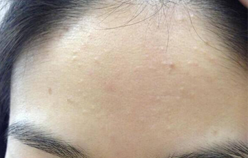 胡兵偏方治胃肠炎的偏方_治痘偏方_去 背后痘印 偏方