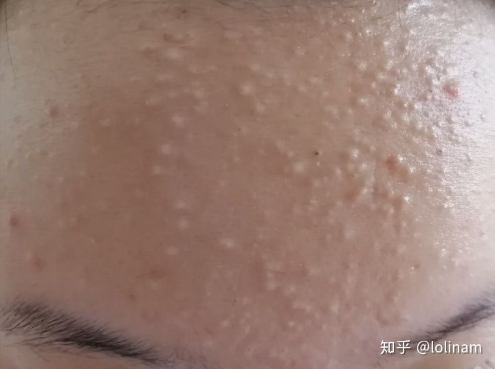 治痘偏方_去 背后痘印 偏方_胡兵偏方治胃肠炎的偏方