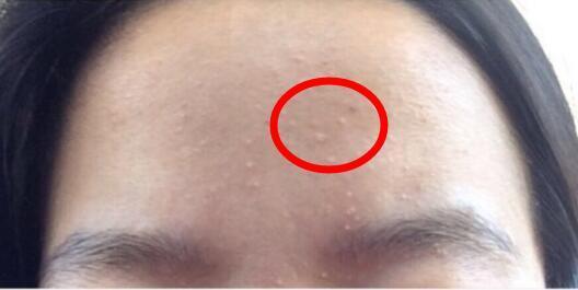 治痘偏方_去 背后痘印 偏方_胡兵偏方治胃肠炎的偏方