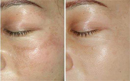 脸上长斑小偏方_脸上长斑的偏方_脸上长斑怎么办