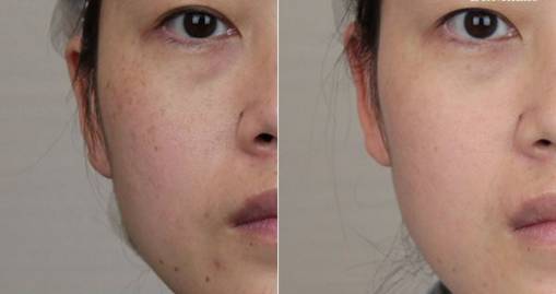 脸上长斑的偏方_脸上长斑怎么办_脸上长斑小偏方