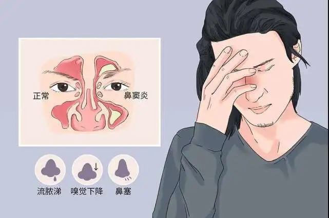 治疗鼻炎的小偏方_治疗儿童鼻炎偏方_苍耳治疗过敏鼻炎偏方
