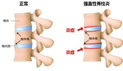 颈椎骨质增生偏方_颈椎骨刺增生_颈椎间盘突出增生