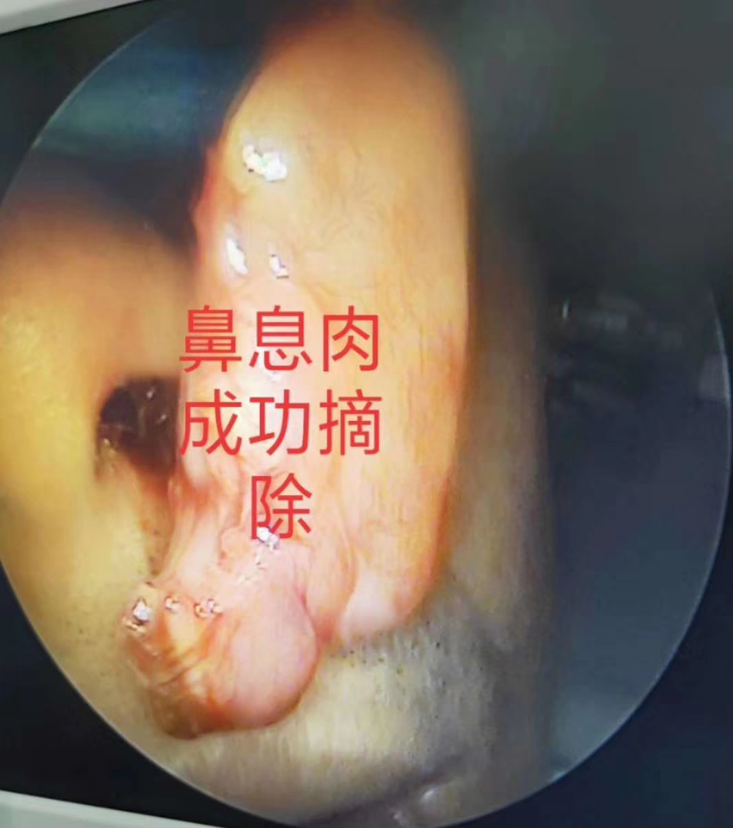 有效治疗鼻息肉的偏方_治疗口腔溃疡偏方 2345偏方大全_治疗鼻息肉的偏方