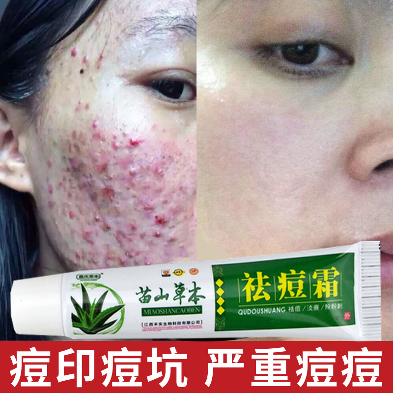 香油祛痘偏方_祛痘的偏方_治咳嗽偏方香油炒鸡蛋