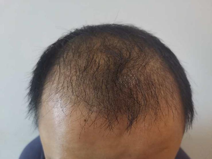 女性脂溢脱发中药偏方_脂溢脱发可以痊愈吗_脂溢性脱发偏方