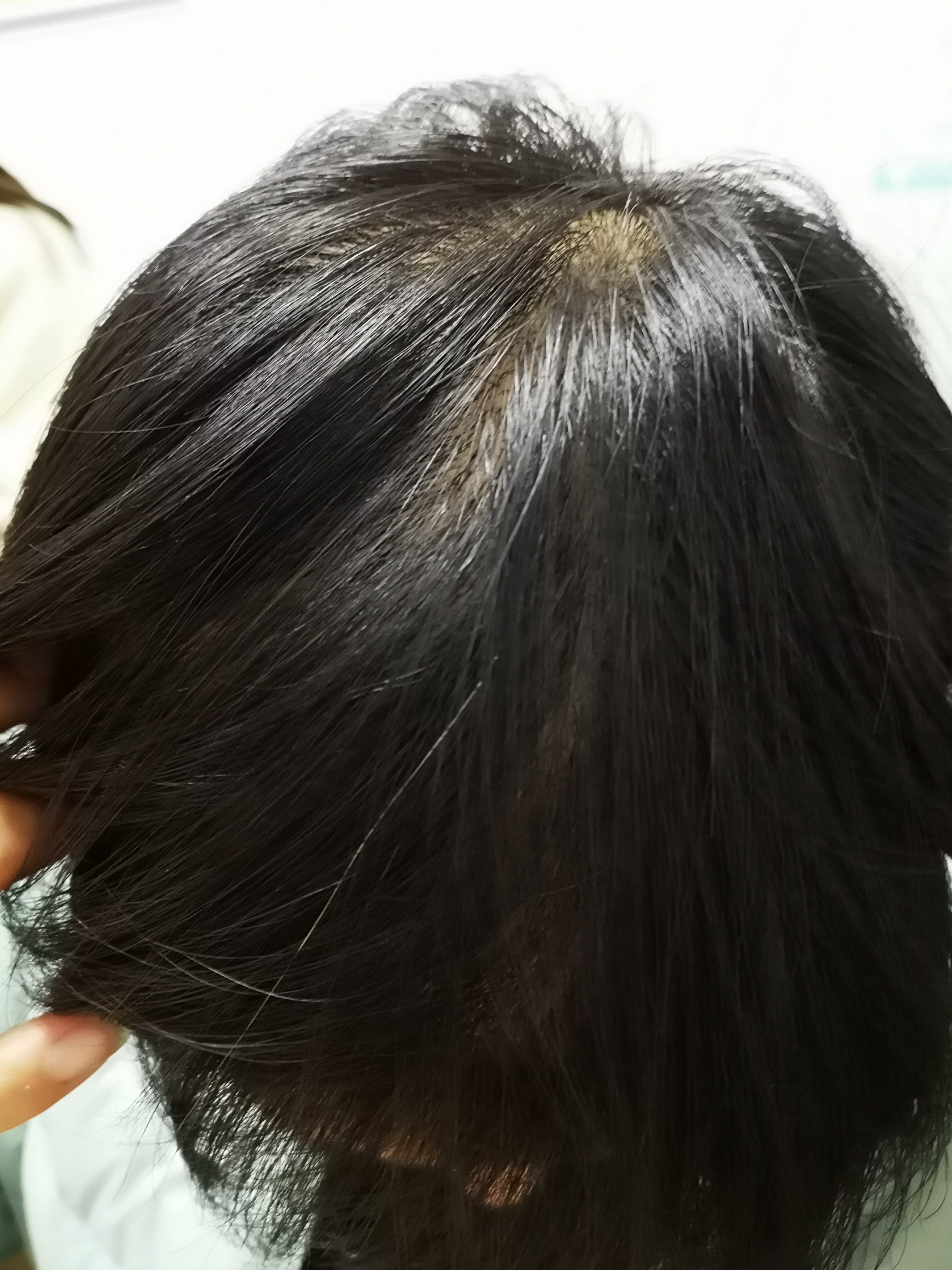脂溢性脱发偏方_女性脂溢脱发中药偏方_脂溢脱发可以痊愈吗