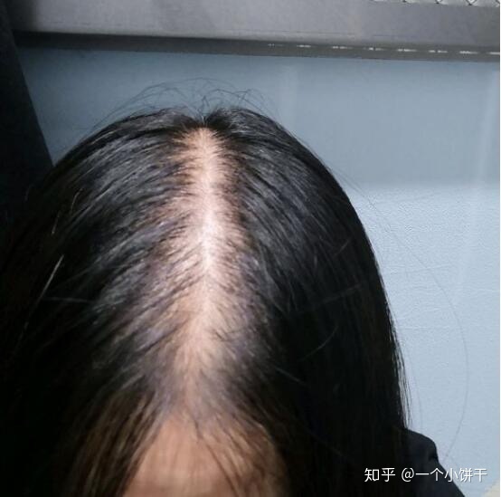 脂溢性脱发偏方_脂溢脱发可以痊愈吗_女性脂溢脱发中药偏方