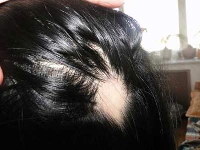 脂溢脱发可以痊愈吗_女性脂溢脱发中药偏方_脂溢性脱发偏方