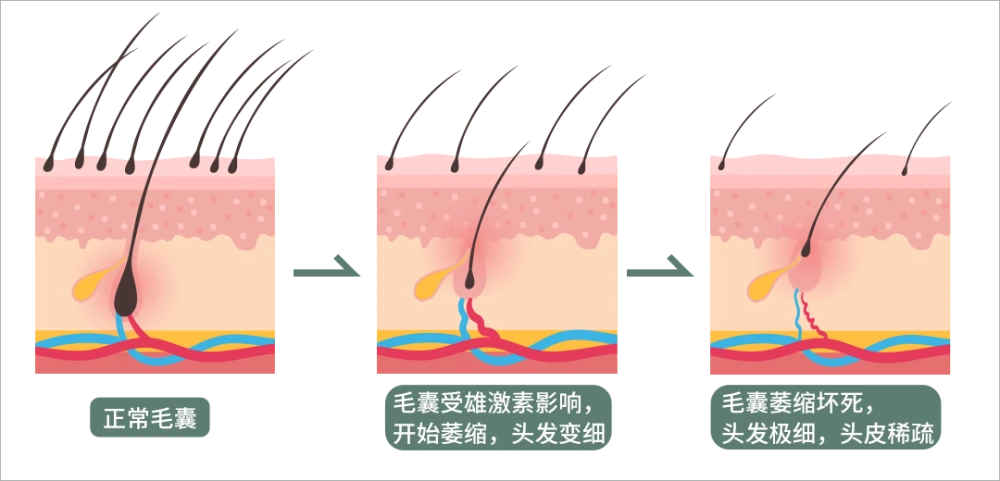 肾虚脱发 脂溢 区别_女性脂溢脱发图片_脂溢性脱发偏方