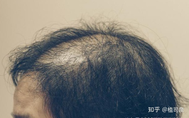 脂溢脱发是永久脱发吗_脂溢性脱发偏方_女性脂溢脱发中药偏方