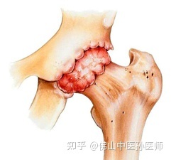 天下一绝治骨质增生_小孩烫伤治好后有点增生用什么药好_骨髓增生异常综合征中医证治