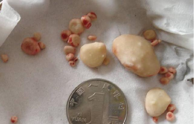 中医秘方:吃上三天让结石自己排出来 结石一吃就化秘方_中华秘方网秘方大全_结石秘方