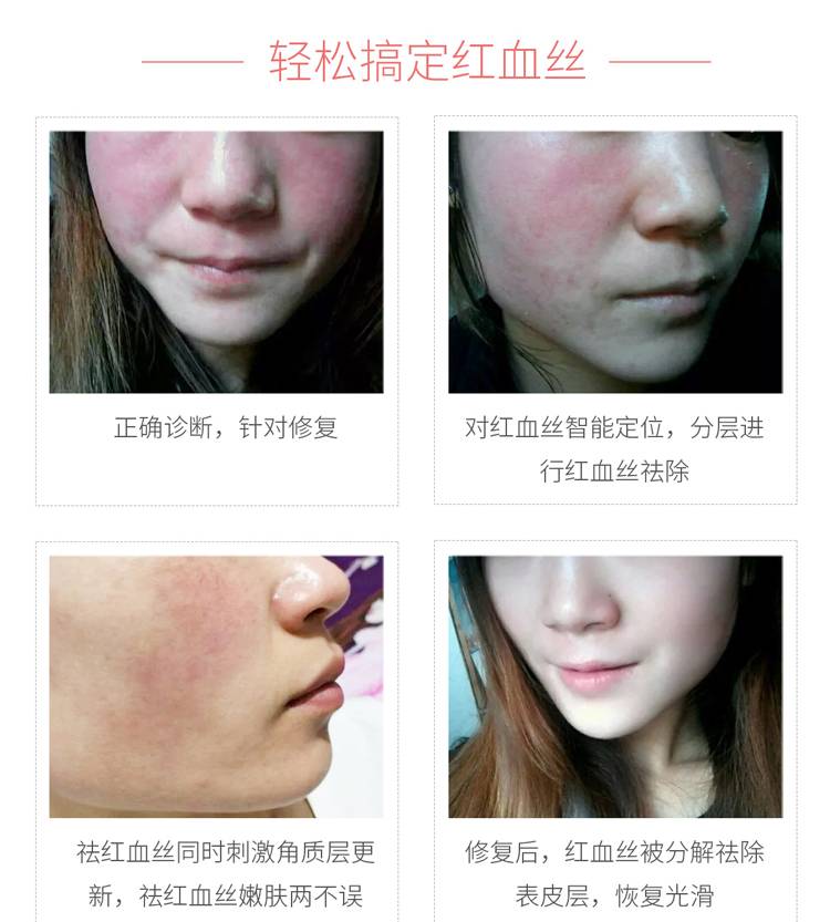 什么产品去红血丝好,红血丝根治的偏方! 小腿外侧血丝偏方_去红血丝的方法偏方_去红血丝偏方