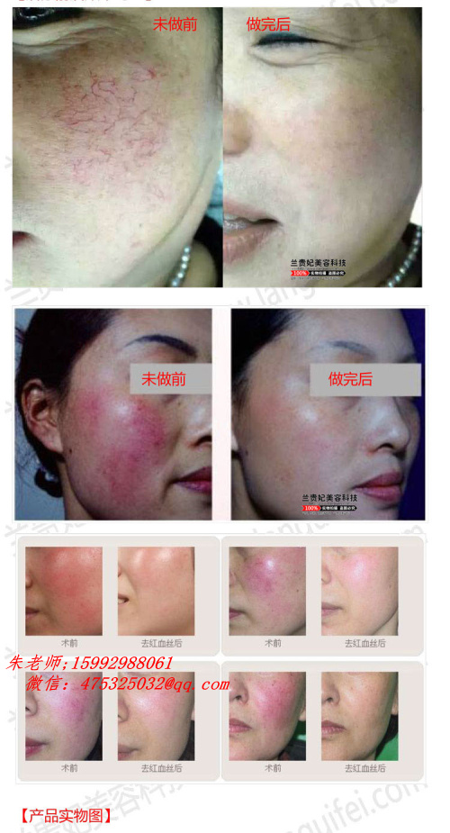 什么产品去红血丝好,红血丝根治的偏方! 小腿外侧血丝偏方_去红血丝偏方_去红血丝的方法偏方