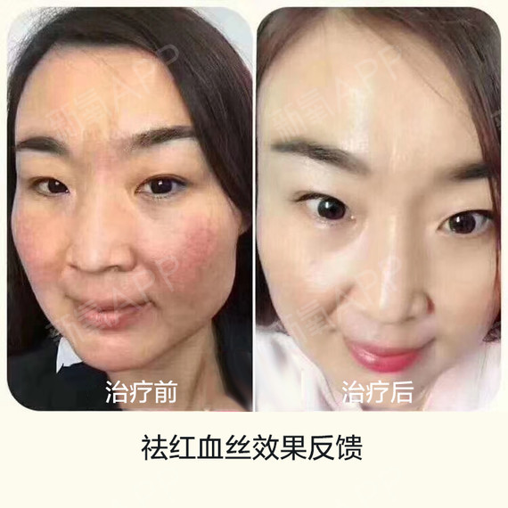 什么产品去红血丝好,红血丝根治的偏方! 去红血丝偏方_去红血丝的方法偏方_小腿外侧血丝偏方